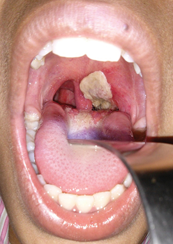 Typical gray-white pseudomembrane in the throat of a patient with diphtheria.
